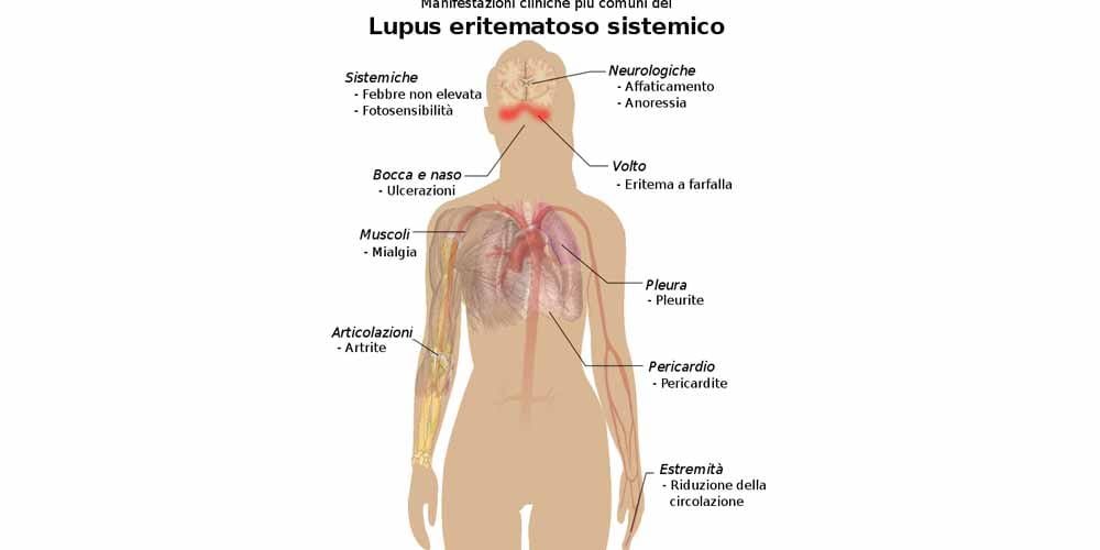 Lupus A volte eccessivo affaticamento puo essere un sintomo