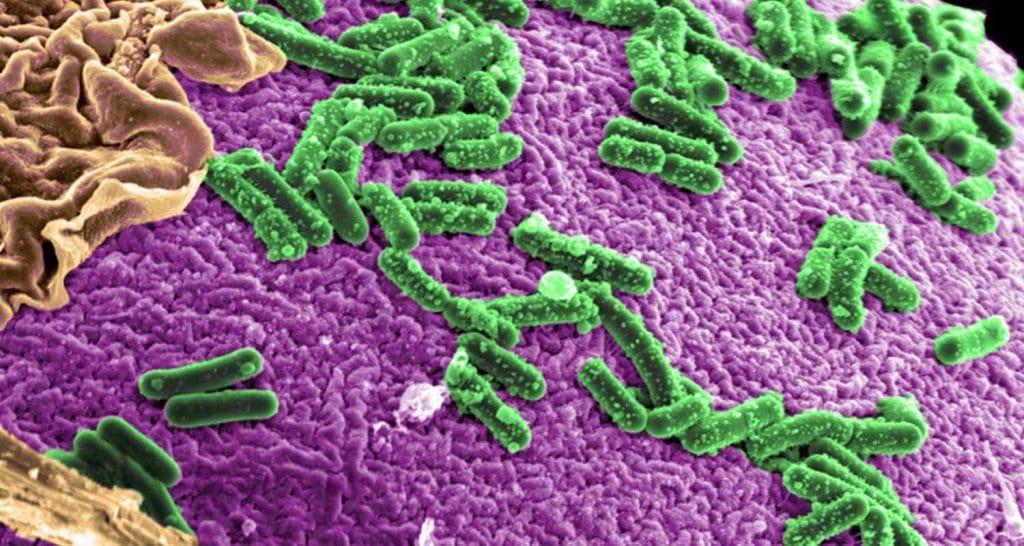 Cancro intestinale alcune sensazioni possono lanciare allarme