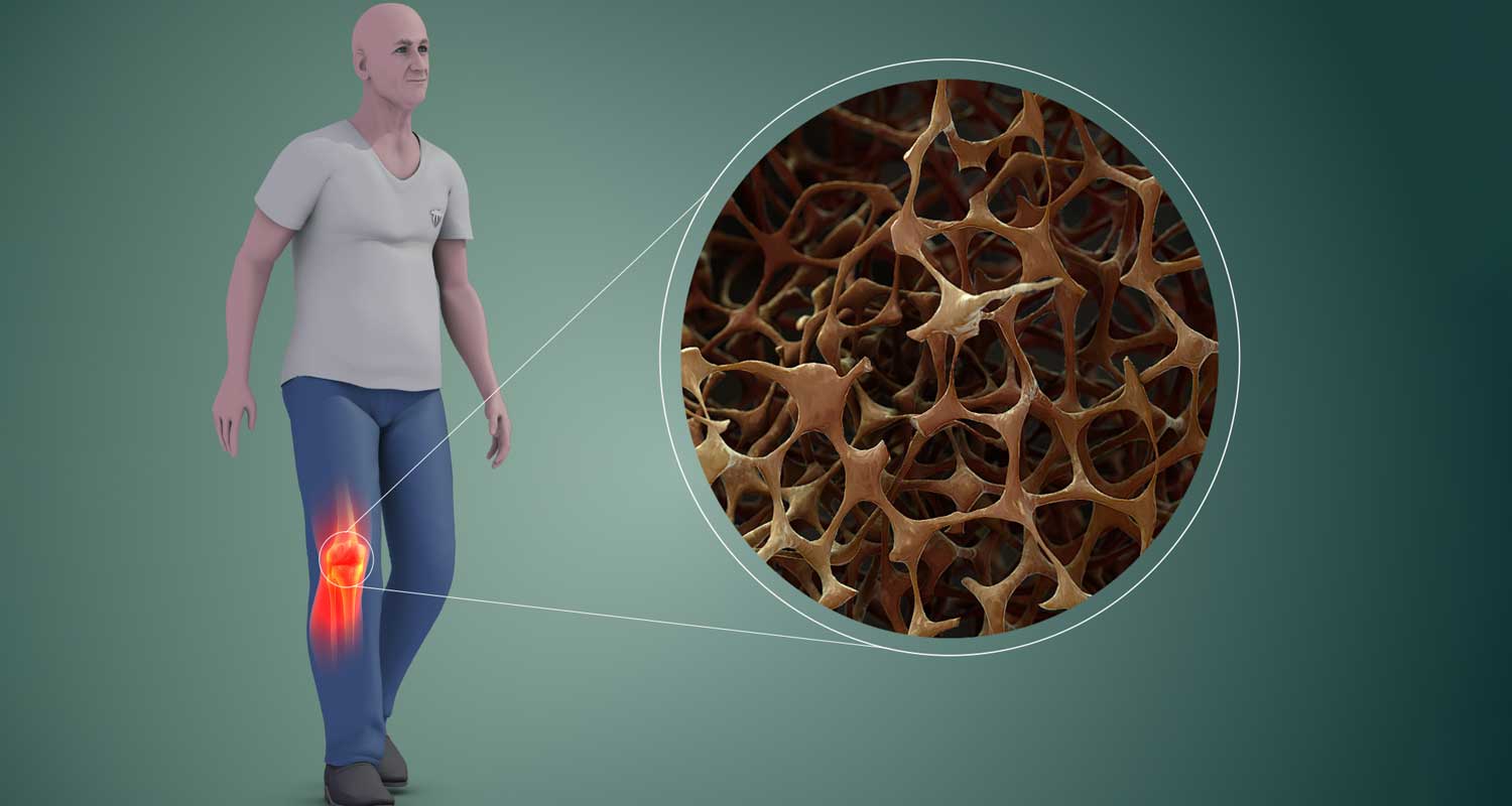 Osteoporosi Come riconoscere i sintomi